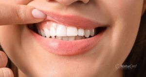 Razones para el oscurecimiento del esmalte dental